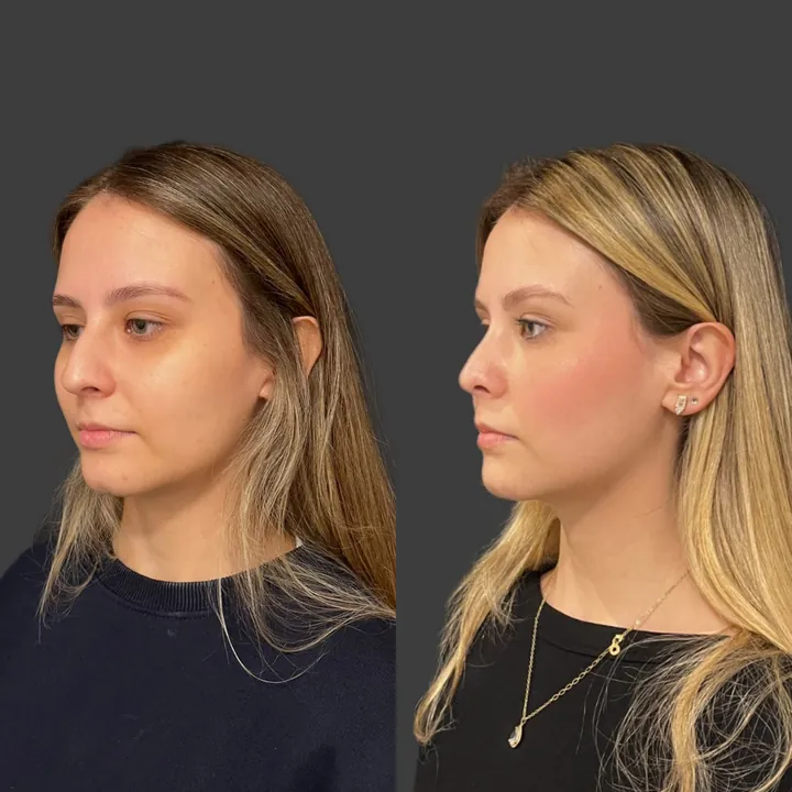 Antes e depois de rinoplastia, foto 7