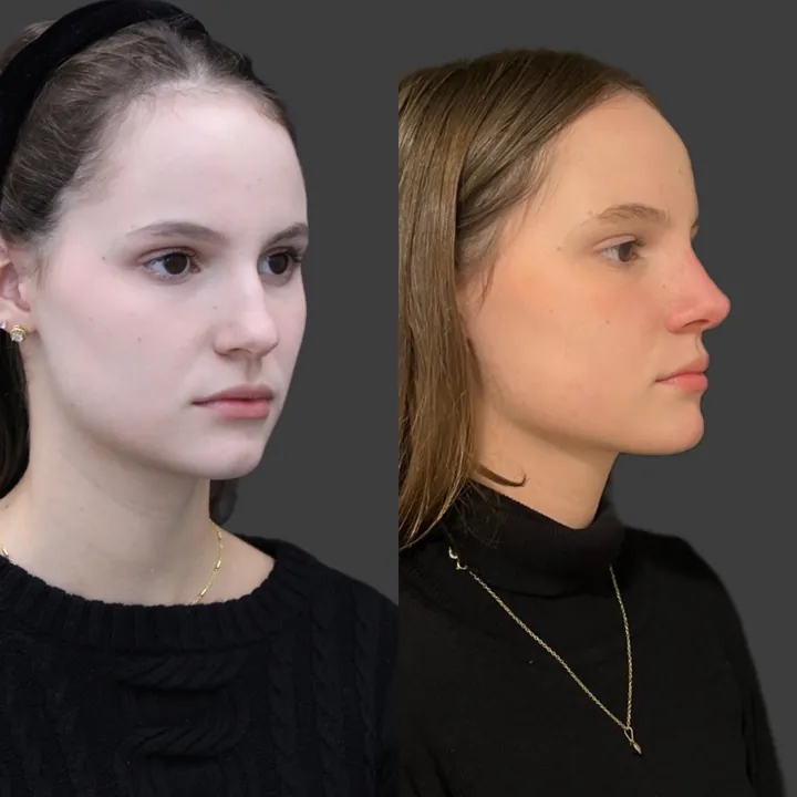 Antes e depois de rinoplastia, foto 11
